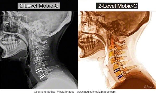 2-Level Mobi-C